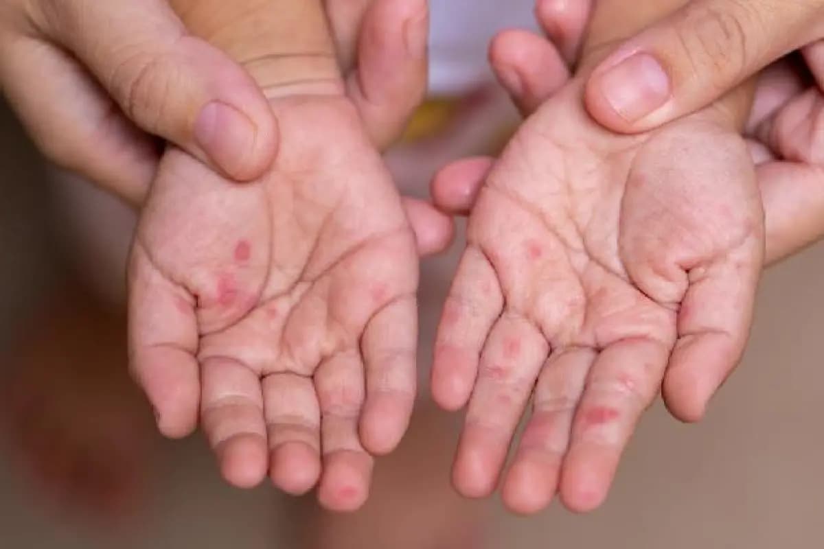 Waspada Campak Pemkot Cimahi Perintahkan Dinkes Lakukan Deteksi Dini